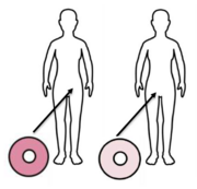 Two drawings of outlines of people with arrows pointing to where the cervix is. Arrows show different coloured donuts