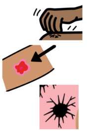 Drawings of a hand itching skin, an arrow pointing to a sore spot on skin and a mole