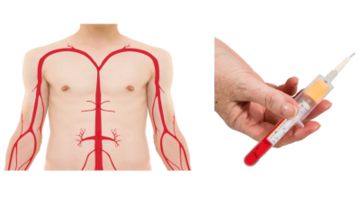 A diagram of the body showing where some veins are next to a photo of a needle with a test tube attached to it which is called a blood vacuum tube