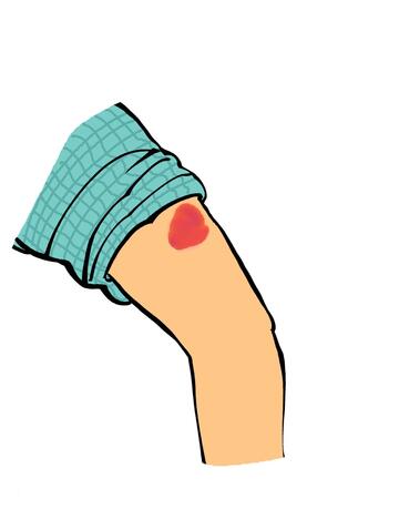 A drawing of an arm with a red mark caused by an insect bite