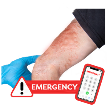 The image shows a person's arm with a rash and the word Emergency and a mobile phone